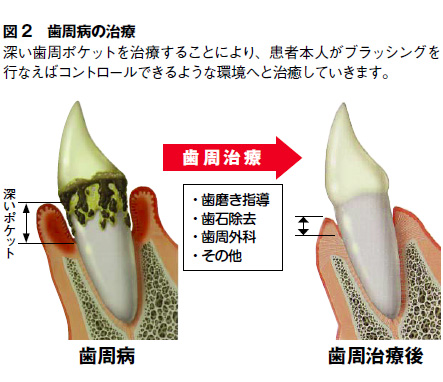 歯周病の治療